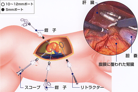 腹腔鏡手術