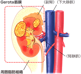 腎摘出術